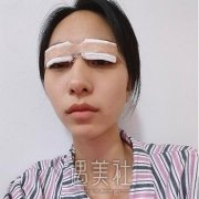 双眼皮恢复照片，真人案例讲述手术前后过程 width=