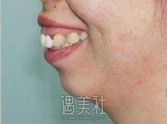 牙齿天包地图片，天包地矫正全过程展示 width=