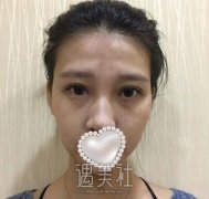 面部凹陷图片对比，自体脂肪移植为颜值加分 width=