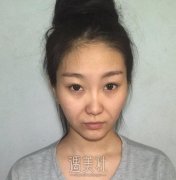 面部提升一到三天变化图，面部提升童颜术案例分享 width=