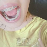天包地嘴唇图片，天包地矫正案例对比图，术后迷人了好多 width=
