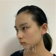 割双眼皮三个月恢复图，真人案例前后对比图展示 width=