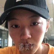 上海九院杨军小睑裂案例，恢复正常，世界都变光明了 width=