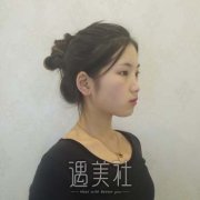 割双眼皮一个月恢复图，手术前后对比照片展示 width=