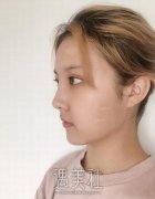 人老了之后鼻唇沟里填充任何东西都很快会消失？真人案例展示 width=