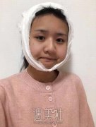 邱立东靠谱新磨骨案例，切除了宽大的下颌角，脸型更精致 width=