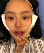祝颂松正颌手术案例，高水准技术帮我改善凸嘴问题 width=