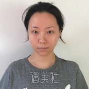 割双眼皮1-40天的恢复图，真人双眼皮案例恢复全过程展示 width=