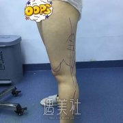 抽脂后身体的变化案例，真人讲述从“胖”变“瘦”的巨大转变 width=