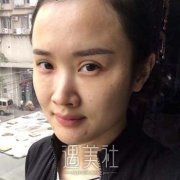 鼻中隔偏曲矫正图片图解案例，重获精致高挺的鼻梁 width=