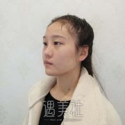 切开双眼皮1到7天图，真人案例展示手术恢复全过程 width=