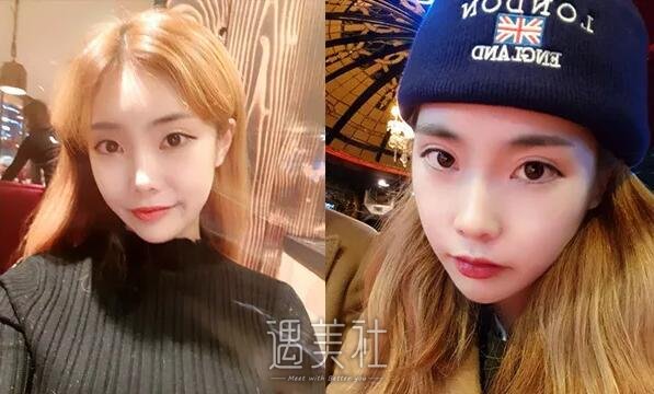 韩国原辰整形医院面部轮廓整形案例：整形前后照片分享~ width=