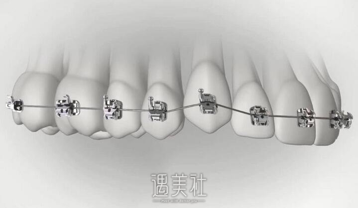 牙齿矫正
