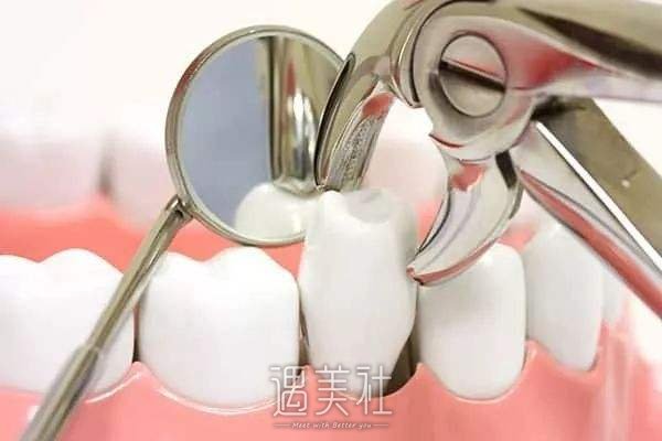 拔牙