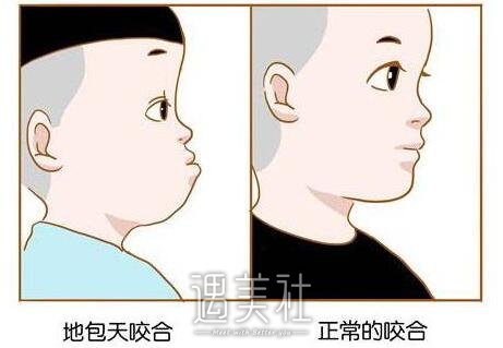 地包天矫正