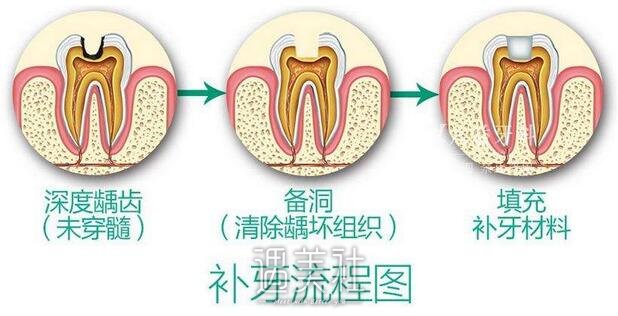 补牙