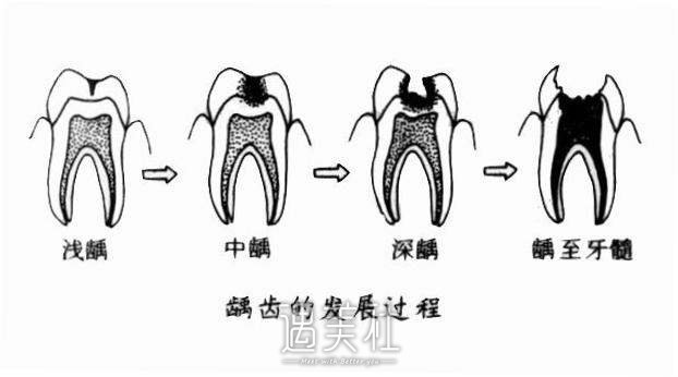 龋齿调节