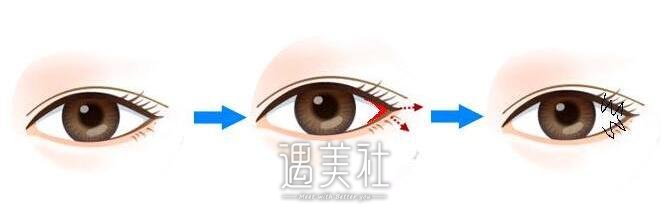 开外眼角